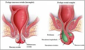 Hemoroizii sunt niste dilatatii venoase patologice (la fel ca varicele) la nivelul canalului anal. Prolapsul Rectal Tratament Chirurgical Minim Invaziv