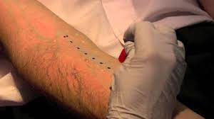 Skin Allergy Testing London Skin Prick Testing London