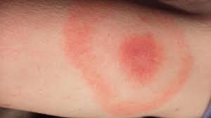 Is Lyme Disease Sexually Transmitted Nutritional Health Care