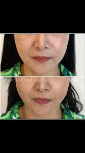 Face thread-lift procedure instant result , Changes