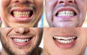 Be prepared when dental costs come your way. Dental Veneers Vs Lumineers Miami Beach Fl Dr Abrahams