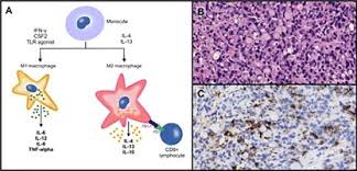 Early signs of stomach cancer may include: The Role Of Tumor Associated Macrophages In Gastric Cancer Development And Their Potential As A Therapeutic Target Sciencedirect