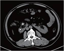 Flexible Ureteroscopic Management Of Horseshoe Kidney Renal Calculi Diagnosing kidney stones usually involves one or more imaging procedures to visualize the urinary tract and kidney stone and is usually accompanied all kidney stones are visible on ct scans. horseshoe kidney renal calculi