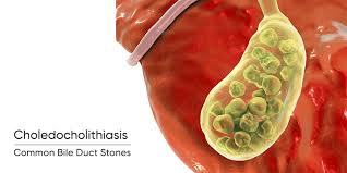 Image result for Choledocholithiasis