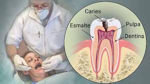 Resultado de imagen de &iquest;C&oacute;mo evitar las caries?