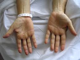 Importantly, like smallpox, there is no known animal reservoir for syphilis. Secondary Syphilis Cancer Therapy Advisor