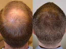 It is intended for use on benign forms of prostatic hyperplasia. Dutasteride For Hair Loss Is It A Feasible Solution Lewigs