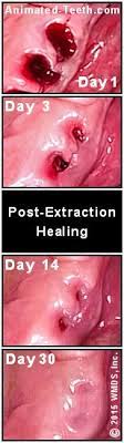 We did not find results for: Tooth Extraction Healing Timeline How Long Does It Take For Bone And Gums To Heal Pictures