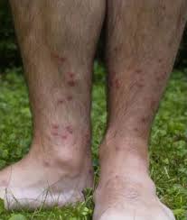 Image result for allergy rash on the legs