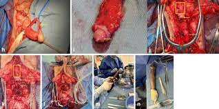 Check spelling or type a new query. Understanding Male To Female Transgender Surgery And Associated Complications A Comprehensive Review Springerlink