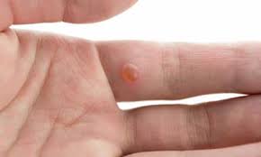 So, what are plantar warts anyway? Genital Wart Removal Consult Professionals For Treatment By Dr Vinod Raina Lybrate