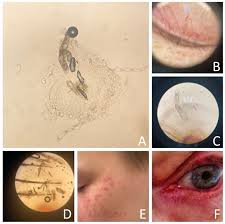 Image result for Demodex folliculorum