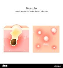Image result for Pustule