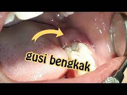 Gusi bengkak adalah salah satu masalah gangguan mulut yang bisa terjadi pada semua orang, mulai dari bayi hingga para manula. Gusi Bengkak Karena Gigi Tumbuh Operasi Bedah Kecil Sakit Gigi Info Kesehatan Jogja Youtube