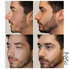 Rhinoplasty Brunswick