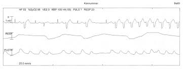 Två ves i följd kallas för ofta, men inte alltid, uppträder ves i vila och försvinner vid ansträngning. Premature Ventricular Contractions Amboss