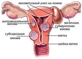 Boli Pri Miome Chto Ukazyvaet Na Nalichie Patologii Gbu Respublikanskij Onkologicheskij Dispanser G Groznyj