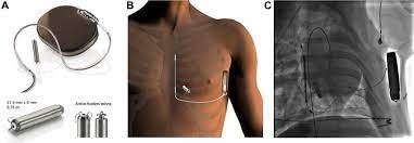 Thin wires connect the icd to your heart. Communicating Atp Enabled Lp And S Icd Download Scientific Diagram