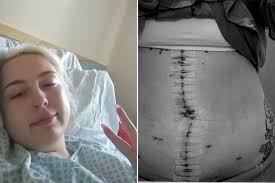 New Mom Diagnosed With Ovarian Cancer at 23 Has Hysterectomy 'For Daughter' 