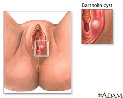 Image result for Bartholin's gland abscess
