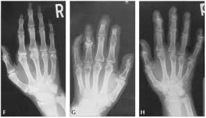 Image result for XRay Changes in Rheumatic Conditions