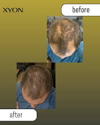 Image result for Minoxidil