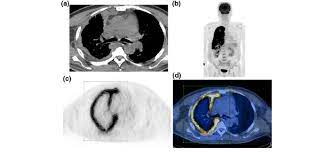 Check spelling or type a new query. Representative Initial Pet Ct Images In A 53 Year Old Man With Download Scientific Diagram