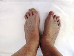 Image result for toe amputation