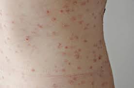 Syfilis je bakteriálne ochorenie prenosné typicky pohlavnou cestou. Gammal Imitator Gor Comeback