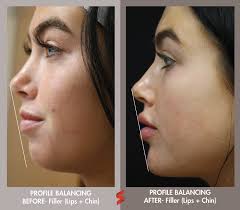 Profile balancing is when we correct a side profile by adding filler to the  chin and lips and/or cheeks to create a more defined and contoured look.  Rebecca recently saw this sweet