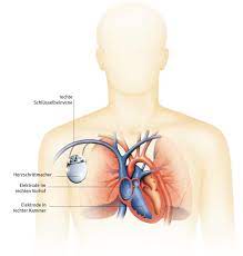 Schlagzeilen zum thema herzschrittmacher pacemaker hsm im my drg archiv und in presseartikeln finden. Herzschrittmacher Kardiologie Aus Dem Gesundheitslexikon Gesundheit Medizin Und Heilkunde Auf Wissen De