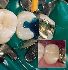 The chemicals in the plastic cement are acetone and butyl acetate (plus cyclohexane if you're not using the extra thin). Plastic Fillings