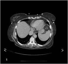 Maybe you would like to learn more about one of these? Primary Peritoneal Epithelioid Mesothelioma Of Clear Cell Type With A Novel Vhl Gene Mutation A Case Report Sciencedirect