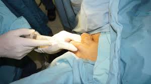 How much does anesthesia cost. Local Anesthesia An Overview Sciencedirect Topics