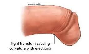 Image result for Chordee