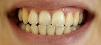 The snow teeth whitening kit works on the whole tooth and not just the surface, which means they can attack the deep stains that have developed over the years of unmanaged staining by soda, coffee, tea, wine, and even cigarette consumption. The Truth About Take Home Led Teeth Whiteners Brite Dental