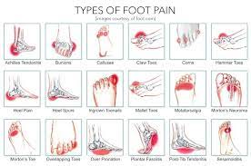 Foot and ankle pain diagnosis chart. Foot Pain Chart
