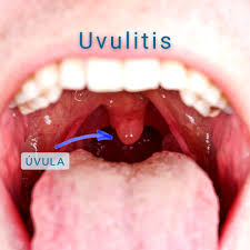 Image result for Uvulitis