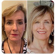 Blackledge Face Center