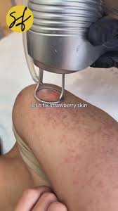 Image result for Keratosis pilaris