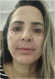 Integrated management of facial harmonization complications using ozone  therapy: A description of 2 cases