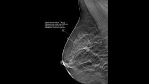 Distress is emotional, mental, social, or spiritual suffering. Cancer Screening Neglected In Fear Of Covid 19