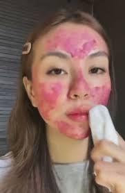 Modal Tepung Pulut Je, Kulit Pulih Daripada Masalah Breakout