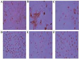 Diagnosing the symptoms of asbestos lung cancer. Targeting Cyclin D1 In Non Small Cell Lung Cancer And Mesothelioma Cells By Antisense Oligonucleotides Anticancer Research