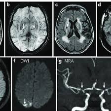 Pdf The Current Role Of Mri In Differentiating Multiple Sclerosis From Its Imaging Mimics