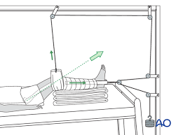 Temp measure to provide support and comfort to a fractured extremity while waiting for more definitive treatment. Traction And Bed Rest For Fracture Of The Femur Distant To The Implant