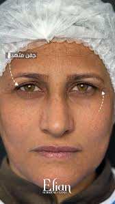 Natural, young, beautiful, Dr. Hilmi, Eye surgeon, Baghdad, Iraq Tel:  +9647724444010 Welcome To The Next LvL®️ #TopSurgeon ‎#عملياتالتجميل  #اجفان#… #blepharoplasty #surgery #… ‎#…#عراق#عمليات_تجميل #بدون_اثر # #…  ‏#drhilmi #hilmieyes #eyelidexpert ...