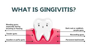 Image result for Gingivitis