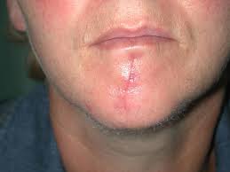 Osterreichische Gesellschaft Fur Dermatochirurgie Ogdc