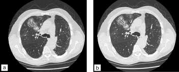L'injection du produit de contraste vous fera ressentir dans le bras puis dans tout le corps une. Scanner Thoracique Ultra Basse Dose La Mort De La Radiographie Thoracique Sciencedirect